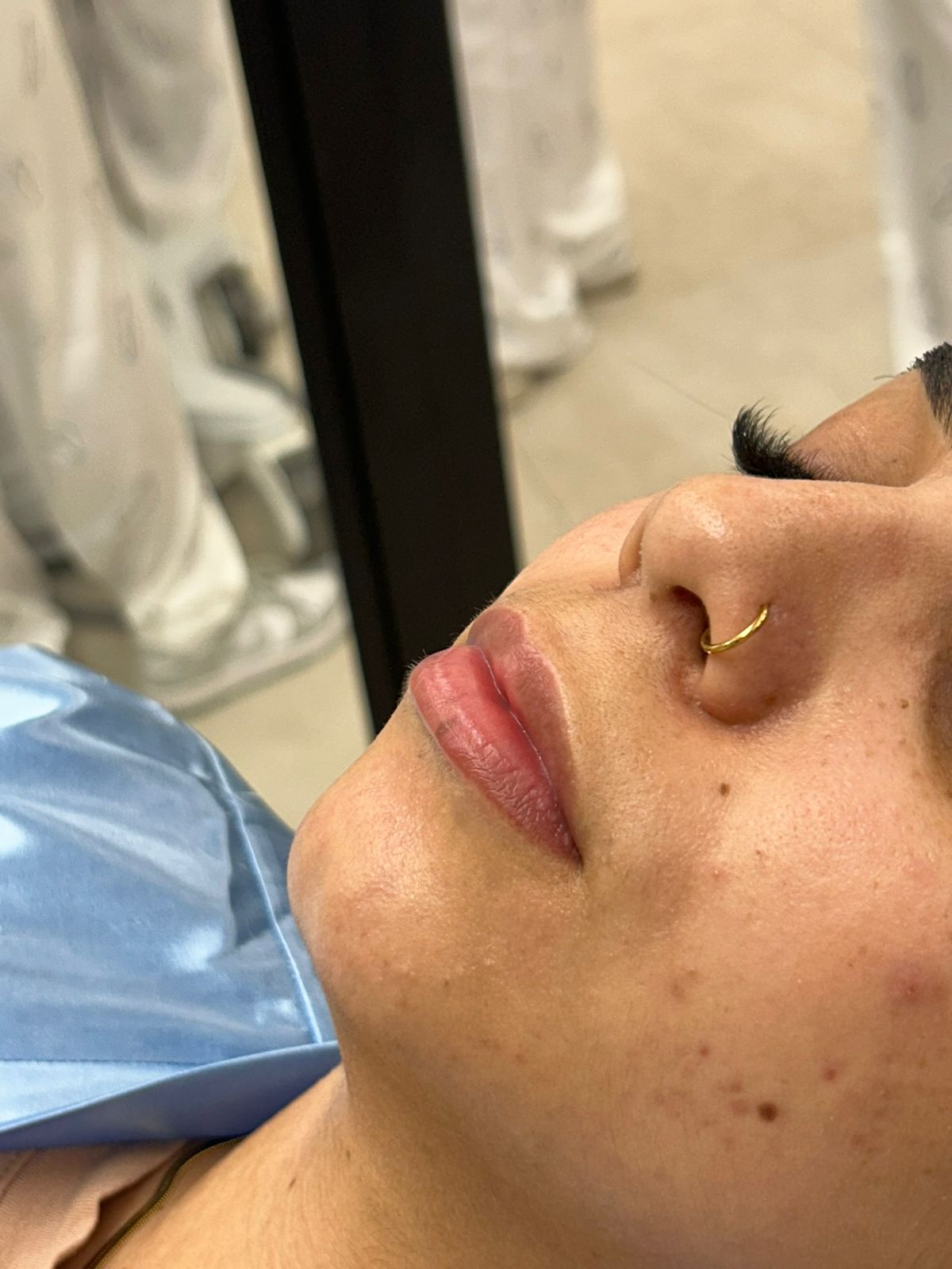 Antes — lábios antes do preenchimento labial